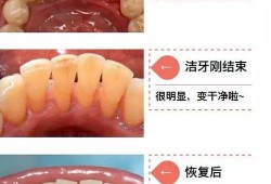 牙齿臭味怎么去除,孕期牙齿臭是什么原因