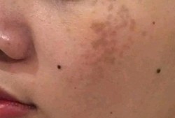 孕期长色斑（妊娠斑是怎么引起的）
