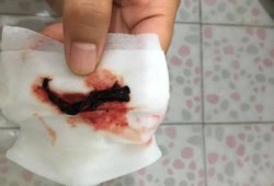 早孕有少量出血是怎么回事,怀孕期间流血块了怎么回事