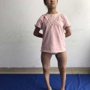 胎儿腿畸形（胎儿腿畸形是什么原因造成的）