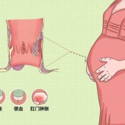 孕期痔疮是什么样子的（孕期痔疮是什么样子的图片）