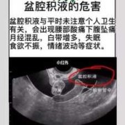 盆腔积液的危害有哪些呢,怀孕检查盆腔积液对胎儿有影响吗