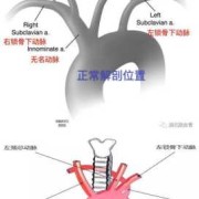 胎儿迷（胎儿迷走右锁骨下动脉什么意思）