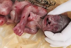 孕妇四维彩超兔唇什么原因,兔唇胎儿图片