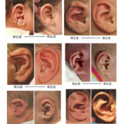 宝宝耳朵怎么会畸形的啊？怀孕期间需要注意哪些呢,吃什么会导致胎儿畸形吗
