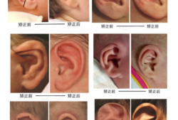 宝宝耳朵怎么会畸形的啊？怀孕期间需要注意哪些呢,吃什么会导致胎儿畸形吗