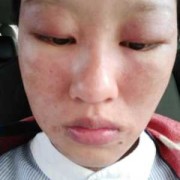 孕妇得了皮炎怎么办，能用药吗,孕妇皮炎影响胎儿吗知乎