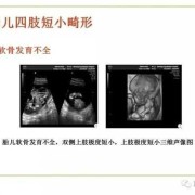 胎儿短肢畸形（胎儿短肢畸形 诊断标准）