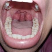 孕妇有炎症对胎儿有影响吗,孕妇扁桃体炎能自愈吗