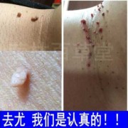 孕七个月胸上长类似扁平疣的东西怎么办,孕期乳晕长疣能亲喂吗