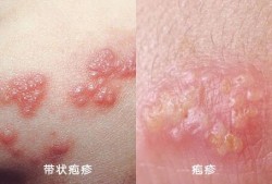 带状疱疹对胎儿的影响（带状疱疹对胎儿的影响）