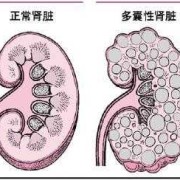 胎儿左肾多囊（胎儿左肾多囊性发育不良原因）