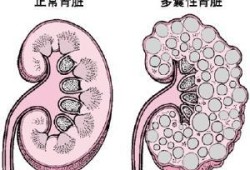 胎儿左肾多囊（胎儿左肾多囊性发育不良原因）