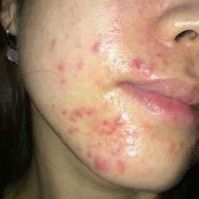 两个嘴角下方长痘怎么回事,孕期嘴角长痘痘什么原因导致的
