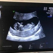 孕期如何检查双性胎儿（一个水晶宝宝能生几个）