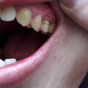 孕期牙断裂（牙齿断裂的原因）