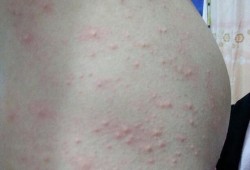 孕妇长痘痘怎么回事,孕期毛囊炎怎么办