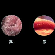 怀孕四个月发现有湿疣湿疣病怎么根治,孕期尖锐疣体需要治疗吗