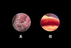 怀孕四个月发现有湿疣湿疣病怎么根治,孕期尖锐疣体需要治疗吗