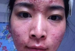 胎儿嘴长（哺乳期嘴巴一圈老是长痘痘是什么原因）