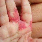 孕妇怎样防止孩子有胎记,如何预防胎儿长胎记在脸上