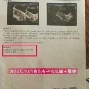 孕期卵巢囊肿怎么办,孕期卵巢囊肿怎么办才好
