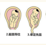 每天蹲着胎儿会畸形吗（每天蹲着胎儿会畸形吗图片）
