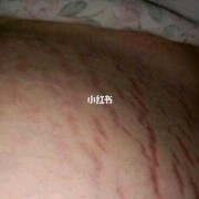 孕期没长妊娠纹生完会有吗（为什么有的女人没有妊娠纹）