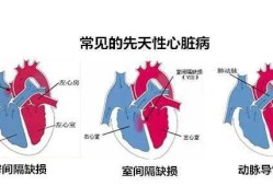 胎儿心脏间隙（胎儿心脏间隙大是什么原因）