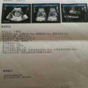 胎儿集合系统分离（四维彩超显示我胎儿左肾集合系统分离7mm，要紧吗）