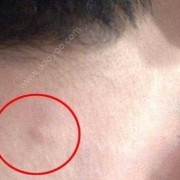 孕期淋巴结（孕期淋巴结发炎对胎儿有影响么）