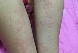孕期胆汁淤积症图片（妊娠期胆汁淤积症有何症状）