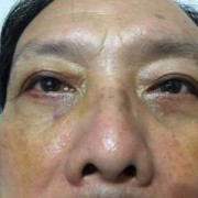 怀孕27周心脏主血管细怎么办,孕期胸部青筋明显是什么原因