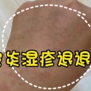 妊娠痒疹应该怎么治疗,孕期湿疹吃什么缓解痒