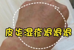 妊娠痒疹应该怎么治疗,孕期湿疹吃什么缓解痒