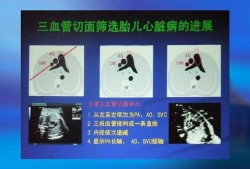 胎儿心脏三血管切面（胎儿心脏三血管切面异常严重吗）
