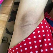 孕期脱毛（孕期脱毛有什么影响）