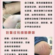 孕期妊娠纹如何去除（孕期妊娠纹如何去除图片）