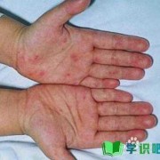 孕期手脚湿疹怎么办（孕期手脚湿疹怎么办啊）