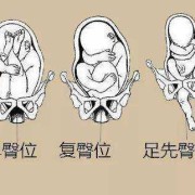 胎儿一直臀位什么原因,胎儿臀位原因造成的
