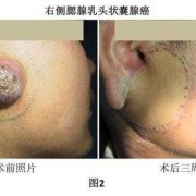 鼻咽顶后壁软组织稍增厚,是什么原因啊,胎儿颈部软组织增厚的原因