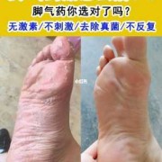 怀孕期间脚气痒怎么办（怀孕期间脚气痒怎么办用什么药）