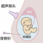 羊穿对胎儿有影响吗（羊穿对胎儿有影响吗?）