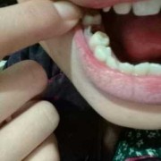 孕期牙洞疼（孕期牙洞疼的厉害怎么办）