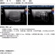 孕31周，b超单上有胎儿脊柱:呈两条串珠状平行排列的强回声带，两者骶尾部相互靠拢且略向后翘，请问正常吗,胎儿脊柱侧弯可以生吗