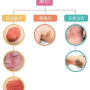 新生儿为什么有胎记,怎样预防胎儿长胎记的发生