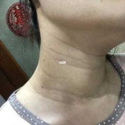 孕期长颈纹怎么办（妊娠纹是横纹还是竖纹）