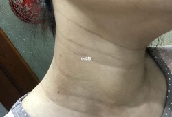 孕期长颈纹怎么办（妊娠纹是横纹还是竖纹）