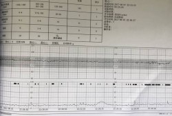 胎儿基线平（胎儿基线平是什么意思）