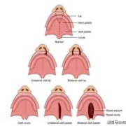 唇腭裂的孩子是怎么造成的,造成胎儿唇裂的主要原因